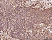 IHC staining of FFPE human lung cancer tissue with RAB5A/B/C antibody. HIER: boil tissue sections in pH8 EDTA for 20 min and allow to cool before testing.