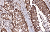 IHC staining of FFPE human adenocarcinoma of the right colon tissue with RAB5A/B/C antibody. HIER: boil tissue sections in pH8 EDTA for 20 min and allow to cool before testing.