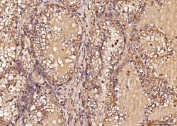 IHC staining of FFPE human renal cell carcinoma tissue with RAB5A/B/C antibody. HIER: boil tissue sections in pH8 EDTA for 20 min and allow to cool before testing.