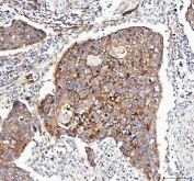 IHC staining of FFPE human esophageal squamous carcinoma tissue with Integrin alpha 3 antibody. HIER: boil tissue sections in pH8 EDTA for 20 min and allow to cool before testing.