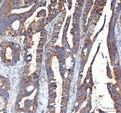 IHC staining of FFPE human colorectal adenocarcinoma tissue with Integrin alpha 3 antibody. HIER: boil tissue sections in pH8 EDTA for 20 min and allow to cool before testing.