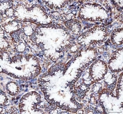 IHC staining of FFPE human lung adenocarcinoma tissue with Integrin alpha 3 antibody. HIER: boil tissue sections in pH8 EDTA for 20 min and allow to cool before testing.