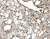 IHC staining of FFPE human renal cell carcinoma tissue with c-Jun antibody. HIER: boil tissue sections in pH8 EDTA for 20 min and allow to cool before testing.