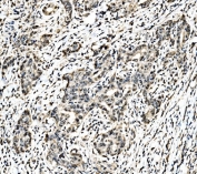 IHC staining of FFPE human renal pelvis squamous metaplasia tissue with c-Jun antibody. HIER: boil tissue sections in pH8 EDTA for 20 min and allow to cool before testing.