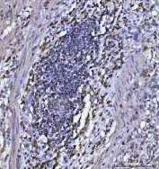 IHC staining of FFPE human gastric carcinoma tissue with CD20 antibody. HIER: boil tissue sections in pH8 EDTA for 20 min and allow to cool before testing.