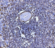 IHC staining of FFPE human splenic rupture tissue with CD20 antibody. HIER: boil tissue sections in pH8 EDTA for 20 min and allow to cool before testing.