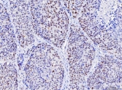 IHC staining of FFPE human liver cancer tissue with MSH2 antibody. HIER: boil tissue sections in pH8 EDTA for 20 min and allow to cool before testing.