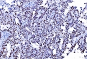 IHC staining of FFPE human serous adenocarcinoma of the ovary tissue with MSH2 antibody. HIER: boil tissue sections in pH8 EDTA for 20 min and allow to cool before testing.