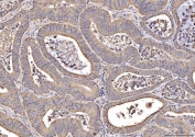 IHC staining of FFPE human colorectal cancer tissue with COX2 antibody. HIER: boil tissue sections in pH8 EDTA for 20 min and allow to cool before testing.