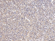 IHC staining of FFPE human glioma tissue with COX2 antibody. HIER: boil tissue sections in pH8 EDTA for 20 min and allow to cool before testing.