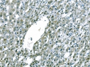 IHC staining of FFPE human liver cancer tissue with CD101 antibody. HIER: boil tissue sections in pH8 EDTA for 20 min and allow to cool before testing.