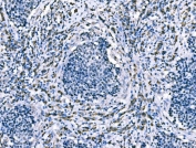IHC staining of FFPE human lung cancer tissue with CD101 antibody. HIER: boil tissue sections in pH8 EDTA for 20 min and allow to cool before testing.