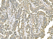 IHC staining of FFPE human rectal cancer tissue with ERp57 antibody. HIER: boil tissue sections in pH8 EDTA for 20 min and allow to cool before testing.