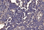 IHC staining of FFPE human bladder epithelial carcinoma tissue with PDIA6 antibody. HIER: boil tissue sections in pH8 EDTA for 20 min and allow to cool before testing.