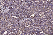 IHC staining of FFPE human ovarian cancer tissue with PDIA6 antibody. HIER: boil tissue sections in pH8 EDTA for 20 min and allow to cool before testing.