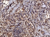 IHC staining of FFPE human breast infiltrating ductal carcinoma tissue with PDIA6 antibody. HIER: boil tissue sections in pH8 EDTA for 20 min and allow to cool before testing.