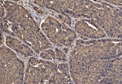 IHC staining of FFPE human liver cancer tissue with PDIA6 antibody. HIER: boil tissue sections in pH8 EDTA for 20 min and allow to cool before testing.