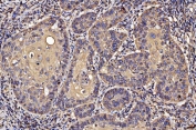 IHC staining of FFPE human laryngeal squamous cell carcinoma tissue with PDIA6 antibody. HIER: boil tissue sections in pH8 EDTA for 20 min and allow to cool before testing.