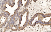 IHC staining of FFPE human endometrial cancer tissue with PDIA6 antibody. HIER: boil tissue sections in pH8 EDTA for 20 min and allow to cool before testing.