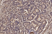 IHC staining of FFPE human colorectal adenocarcinoma tissue with PDIA6 antibody. HIER: boil tissue sections in pH8 EDTA for 20 min and allow to cool before testing.