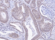 IHC staining of FFPE human intestinal cancer tissue with TOX antibody. HIER: boil tissue sections in pH8 EDTA for 20 min and allow to cool before testing.