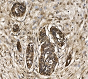 IHC staining of FFPE human cervical intraepithelial neoplasia tissue with Proteasome 20S beta 7 antibody. HIER: boil tissue sections in pH8 EDTA for 20 min and allow to cool before testing.