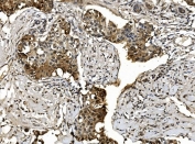 IHC staining of FFPE human invasive breast carcinoma tissue with Proteasome 20S beta 7 antibody. HIER: boil tissue sections in pH8 EDTA for 20 min and allow to cool before testing.