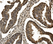 IHC staining of FFPE human ovarian serous adenocarcinoma tissue with Proteasome 20S beta 7 antibody. HIER: boil tissue sections in pH8 EDTA for 20 min and allow to cool before testing.