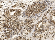 IHC staining of FFPE human renal clear cell carcinoma tissue with Proteasome 20S beta 7 antibody. HIER: boil tissue sections in pH8 EDTA for 20 min and allow to cool before testing.