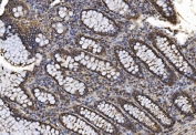 IHC staining of FFPE human colorectal cancer tissue with Proteasome 20S beta 7 antibody. HIER: boil tissue sections in pH8 EDTA for 20 min and allow to cool before testing.