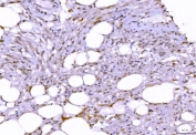 IHC staining of FFPE human smooth muscle fatty carcinoma of the left kidney tissue with PTP1C antibody. HIER: boil tissue sections in pH8 EDTA for 20 min and allow to cool before testing.