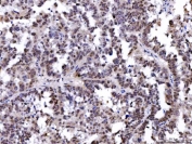 IHC staining of FFPE human serous adenocarcinoma of the ovary tissue with PTP1C antibody. HIER: boil tissue sections in pH8 EDTA for 20 min and allow to cool before testing.