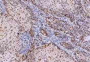 IHC staining of FFPE human laryngeal squamous cell carcinoma tissue with PTP1C antibody. HIER: boil tissue sections in pH8 EDTA for 20 min and allow to cool before testing.
