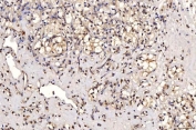IHC staining of FFPE human renal clear cell carcinoma tissue with PTP1C antibody. HIER: boil tissue sections in pH8 EDTA for 20 min and allow to cool before testing.