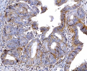IHC staining of FFPE human endometrial cancer tissue with Poliovirus Receptor antibody. HIER: boil tissue sections in pH8 EDTA for 20 min and allow to cool before testing.