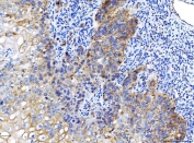 IHC staining of FFPE human laryngeal squamous cell carcinoma tissue with Poliovirus Receptor antibody. HIER: boil tissue sections in pH8 EDTA for 20 min and allow to cool before testing.