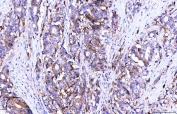 IHC staining of FFPE human colorectal adenocarcinoma tissue with Poliovirus Receptor antibody. HIER: boil tissue sections in pH8 EDTA for 20 min and allow to cool before testing.