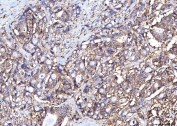 IHC staining of FFPE human colorectal adenocarcinoma tissue with Poliovirus Receptor antibody. HIER: boil tissue sections in pH8 EDTA for 20 min and allow to cool before testing.