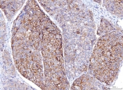 IHC staining of FFPE human liver cancer tissue with Poliovirus Receptor antibody. HIER: boil tissue sections in pH8 EDTA for 20 min and allow to cool before testing.