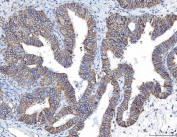 IHC staining of FFPE human endometrial cancer tissue with Poliovirus Receptor antibody. HIER: boil tissue sections in pH8 EDTA for 20 min and allow to cool before testing.