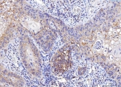 IHC staining of FFPE human laryngeal squamous cell carcinoma tissue with Poliovirus Receptor antibody. HIER: boil tissue sections in pH8 EDTA for 20 min and allow to cool before testing.