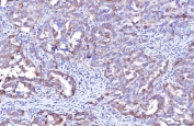 IHC staining of FFPE human ovarian cancer tissue with Poliovirus Receptor antibody. HIER: boil tissue sections in pH8 EDTA for 20 min and allow to cool before testing.