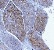IHC staining of FFPE human liver cancer tissue with Poliovirus Receptor antibody. HIER: boil tissue sections in pH8 EDTA for 20 min and allow to cool before testing.