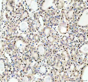 IHC staining of FFPE human thyroid cancer tissue with RAD50 antibody, HRP-secondary and DAB substrate. HIER: boil tissue sections in pH8 EDTA for 20 min and allow to cool before testing.