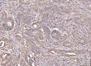 IHC staining of FFPE human colorectal carcinoma tissue with Ran GTPase-activating protein 1 antibody. HIER: boil tissue sections in pH8 EDTA for 20 min and allow to cool before testing.