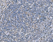 IHC staining of FFPE human lymphoma tissue with Superoxide Dismutase 2 antibody. HIER: boil tissue sections in pH8 EDTA for 20 min and allow to cool before testing.