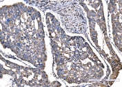 IHC staining of FFPE human adenocarcinoma of the right colon tissue with Superoxide Dismutase 2 antibody. HIER: boil tissue sections in pH8 EDTA for 20 min and allow to cool before testing.
