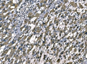 IHC staining of FFPE human liver cancer tissue with Superoxide Dismutase 2 antibody. HIER: boil tissue sections in pH8 EDTA for 20 min and allow to cool before testing.