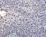 IHC staining of FFPE human laryngeal squamous cell carcinoma tissue with SUB1 antibody. HIER: boil tissue sections in pH8 EDTA for 20 min and allow to cool before testing.