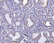 IHC staining of FFPE human poison impregnated thyroid gland tissue with SUB1 antibody. HIER: boil tissue sections in pH8 EDTA for 20 min and allow to cool before testing.